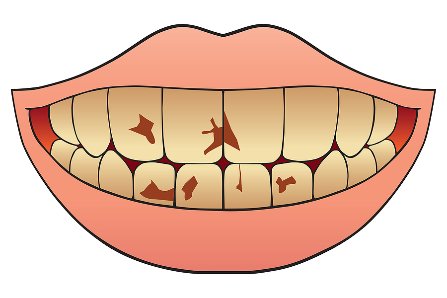 Your Dentist in Framingham Wants You to Avoid Gum Disease: What’s the Difference between Plaque and Tartar?