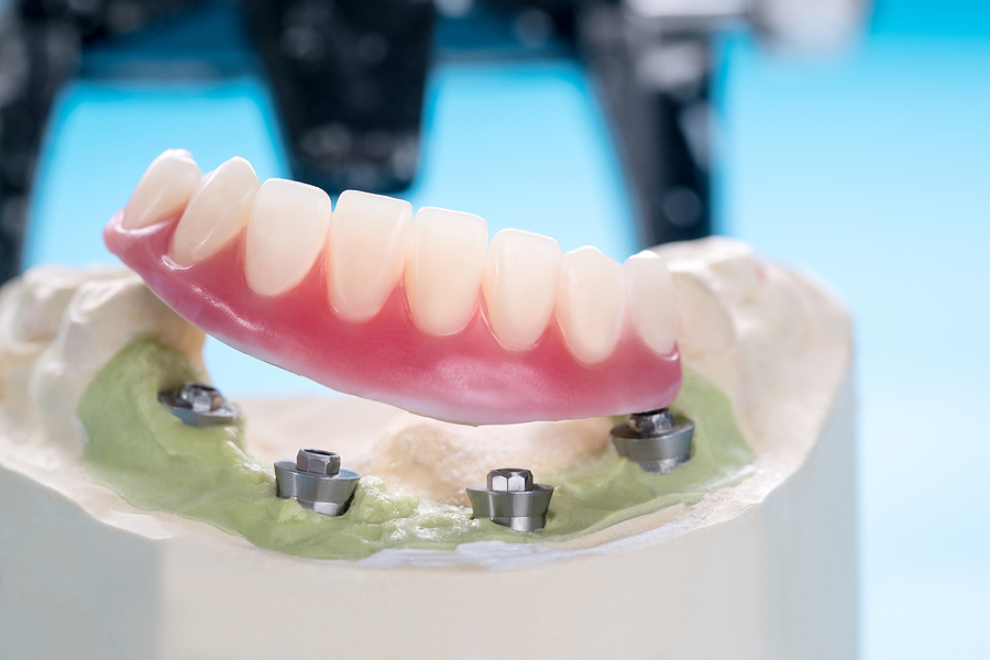 Safe, Expert Dental Implants in Farmingham, MA