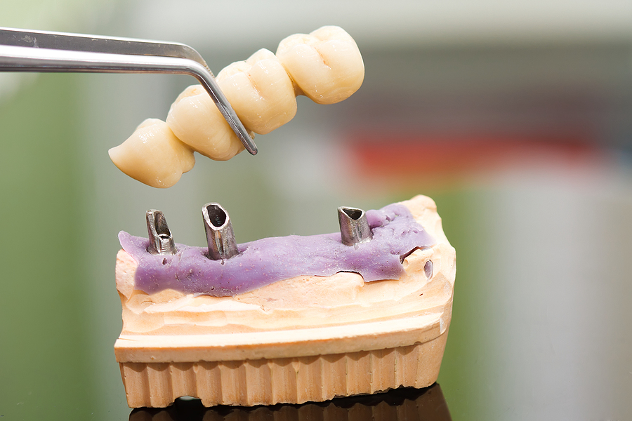 For Dental Implants, Framingham, MA, Residents Turn to Dr. Fried