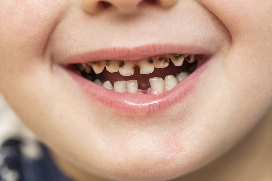 Is It OK to Pull a Loose Tooth? Children’s Dentist Answers
