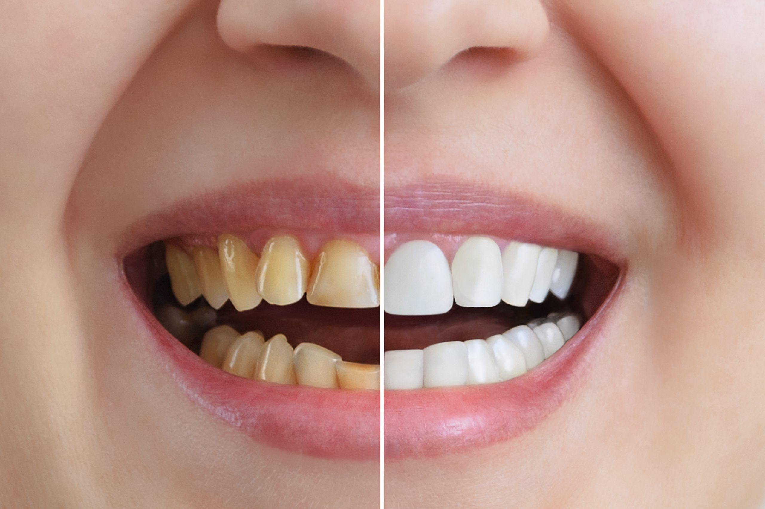 Professional Teeth Whitening in Framingham, MA