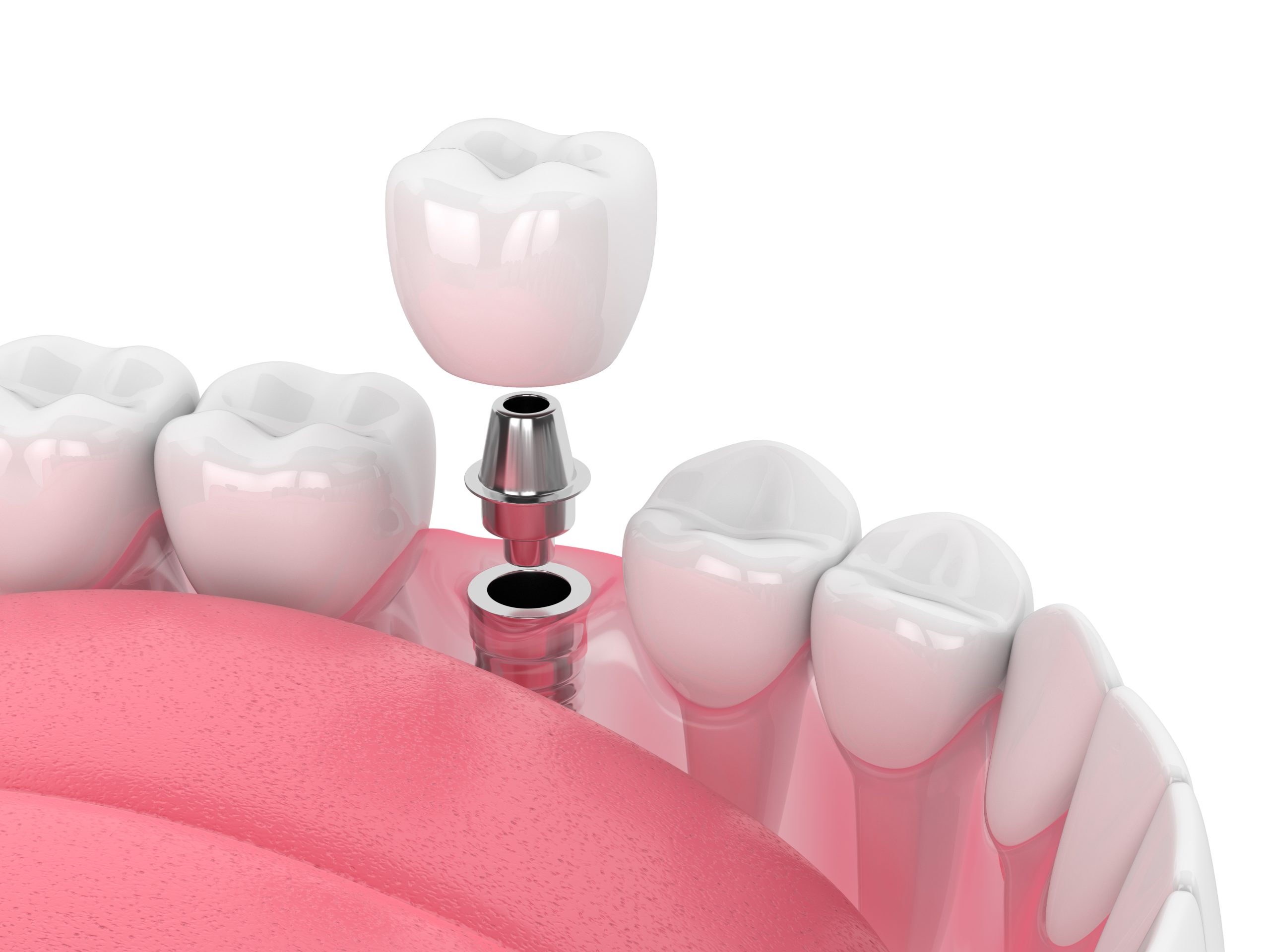 Are Dental Implants in Framingham Right for My Smile?